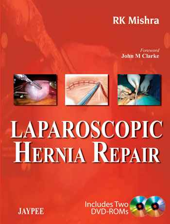 Laparoscopic Hernia Repair